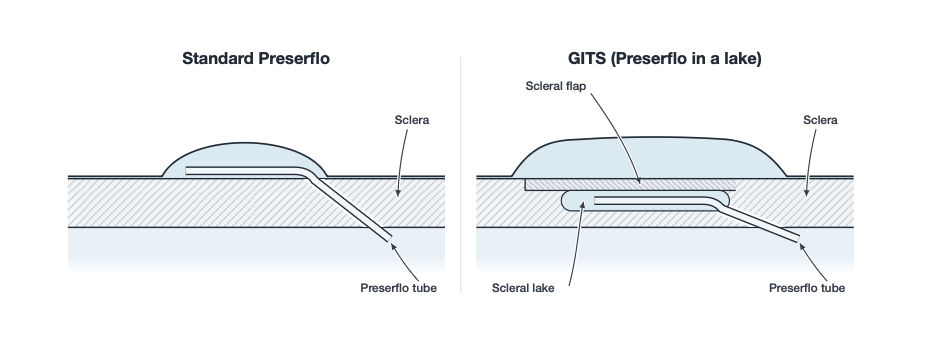 Glaucoma intrascleral tube surgery Illustration