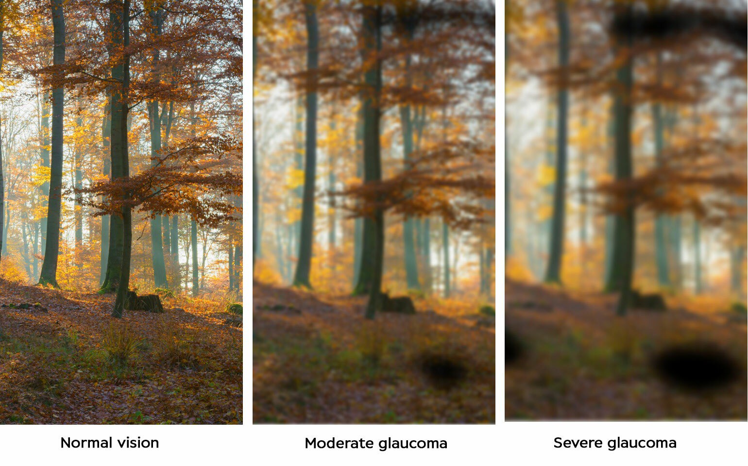 Examples of normal vision, moderate glaucoma and severe glaucoma